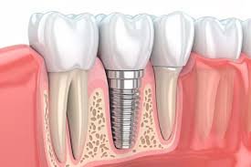 Why Dental Implant Technology is Revolutionizing Modern Dentistry in 2026